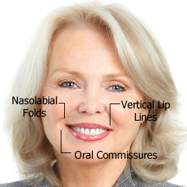 Juvederm Brownwood TX