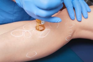 Laser Vein Treatment