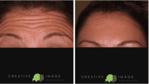 Before and After Dysport® Injection in Abilene TX