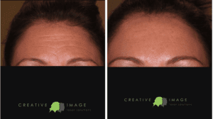 Before and After Dysport® Injection in Brownwood TX