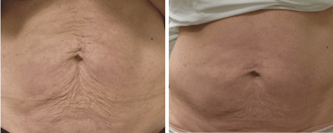 A before and after image set of a woman that underwent a laser skin tighenting procedure on her belly