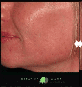 laser skin tightening before photo creative image laser solutions brownwood, texas