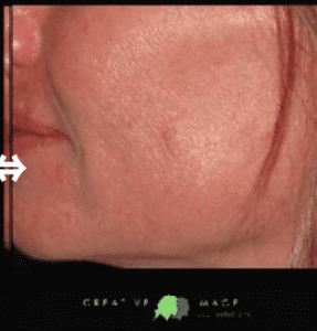After Laser Skin Tightening in Abilene TX