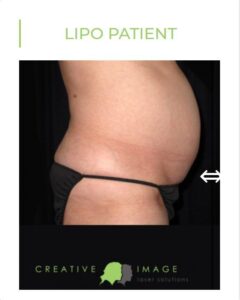 SmartLipo Laser-assisted lipolysis brownwood texas creative image laser solutions before photo