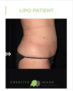 SmartLipo Laser-assisted lipolysis brownwood texas creative image laser solutions after photo