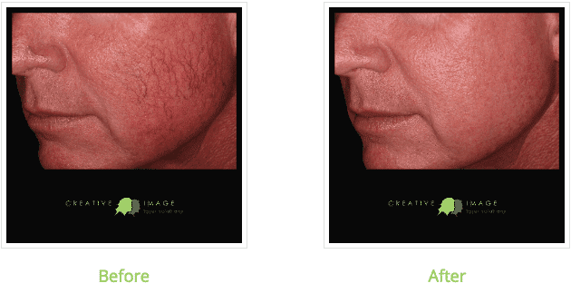 Before and after images of a man that underwent SmartSkin Fractional CO2 Laser TX