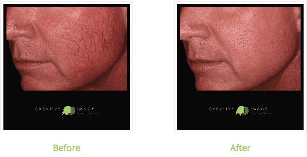 Before and after SmartSkin Fractional CO2 Laser brownwood