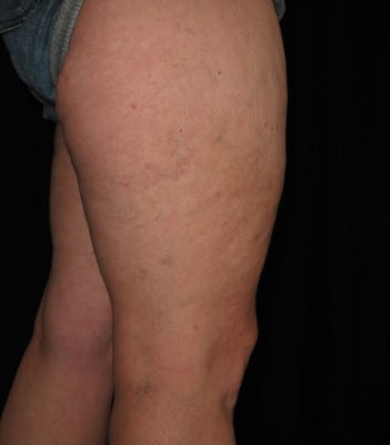 IPL Laser Vein at Creative Image Laser Solutions in Brownwood TX after photo