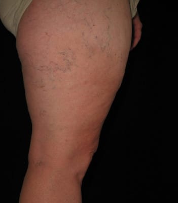 IPL Laser Vein at Creative Image Laser Solutions in Brownwood TX before photo
