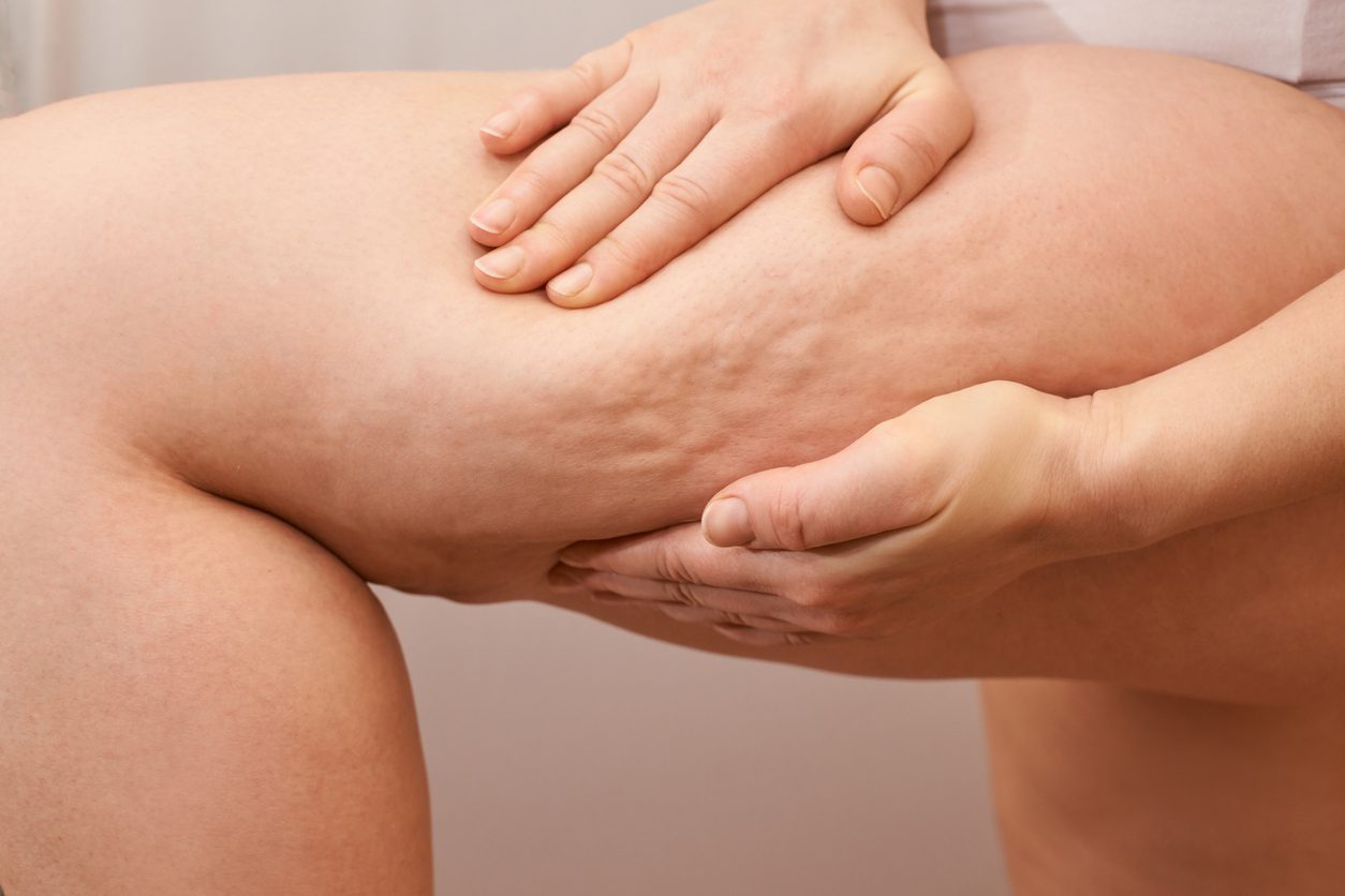 Cellulite Treatment in Brownwood TX