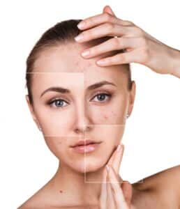 Acne Treatment Brownwood, TX