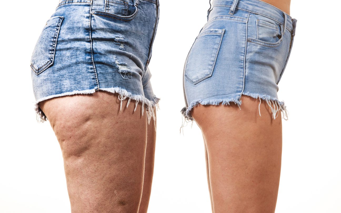 Cellulite Treatment in Abilene TX