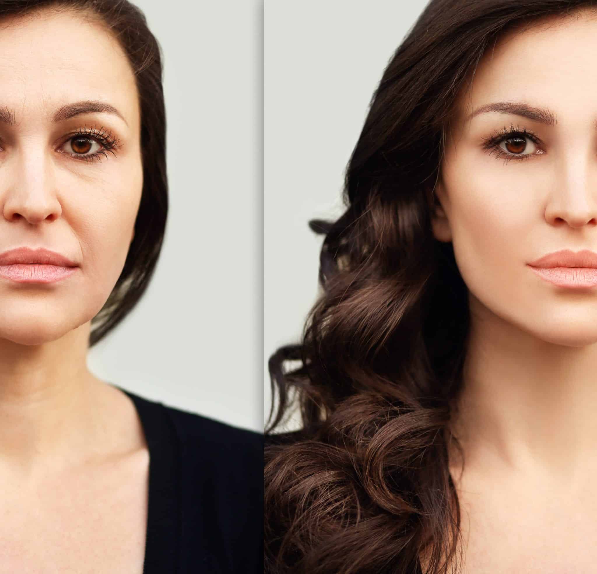 Chemical Peels Brownwood TX