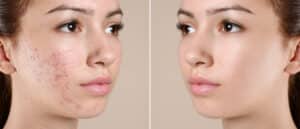 Woman with acne receives treatment for clearer complexion.