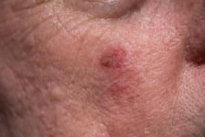 Close-up image of actinic keratosis sunspot on a patient's face that can be treated easily in early stages.
