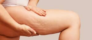 Close up of a woman squeezing her thigh that has cellulite, in need of treatment like truSculpt ID.