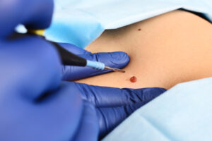 A doctor examines a suspicious mole that may be the source of skin cancer.